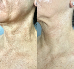 hydrafacial before after Brea Spa at the Glen